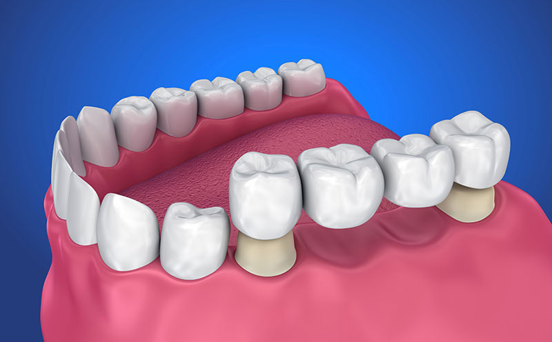 teeth bridges aesthetic clinic perinthalmanna